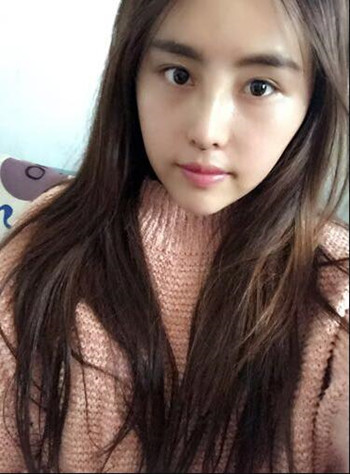 我在南昌佳美做的隆鼻整形+光纤溶脂去双下巴 果真的很不错