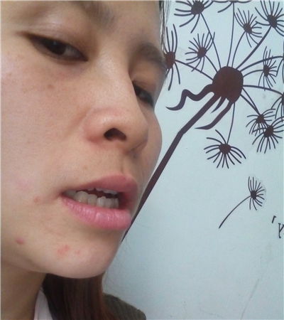 牙齿矫正手术恢复过程和前后对比果图片分享，华西做的哈~