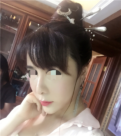 北京延世金慧燕做的果酸嫩肤，分享手术过程和前后对比果照片~