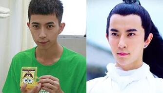 于朦胧垫下巴手术前后对比图