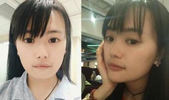 下巴整形前后对比图