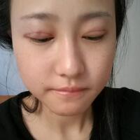 割双眼皮恢复过程分享，整形价格3800元