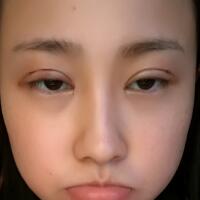 割双眼皮恢复过程分享，整形价格3800元