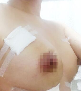 自体脂肪丰胸的果好的没话说，胸部丰满太多了