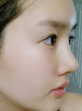 隆鼻术失败修复整形术后果分享