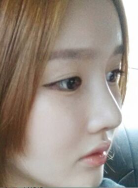 隆鼻术失败修复整形术后果分享