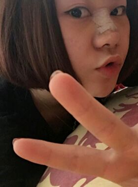 隆鼻整形前后对比照片 果是不是很好呀