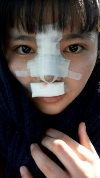 隆鼻整形手术后  我的高鼻梁养成记 内有果对比图
