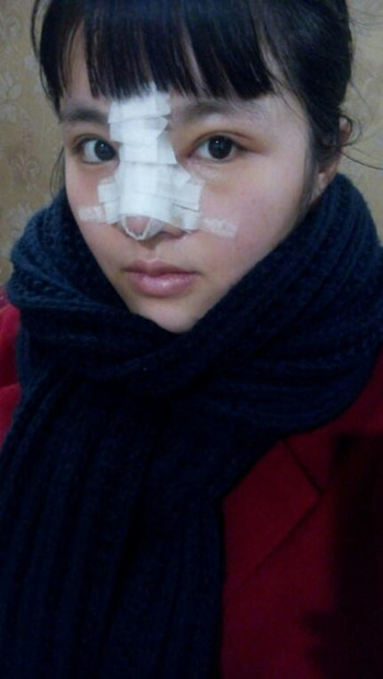 隆鼻整形手术后  我的高鼻梁养成记 内有果对比图