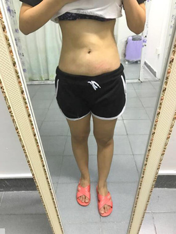 我的腰腹部吸脂减肥真实案例