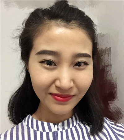 玻尿酸注射隆鼻前后对比果图片分享，大同美神贾文医生做的~