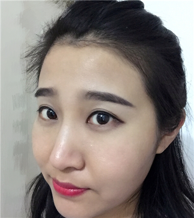 玻尿酸注射隆鼻前后对比果图片分享，大同美神贾文医生做的~