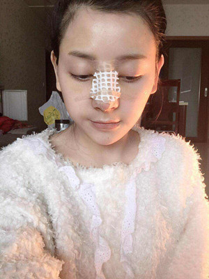 自体软骨隆鼻手术前后过程以及对比照片分享