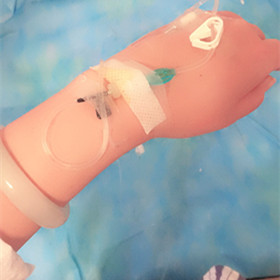 大腿抽脂手术后，还我小细腿!还有对比照片哟!