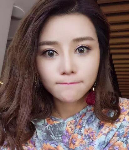 自体脂肪填充后恢复图 孟明星自体脂肪面部填充
