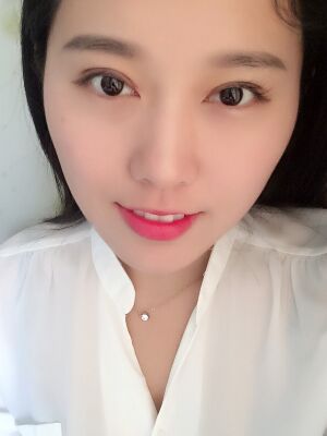 双眼皮失败修复手术恢复超自然，看起来一点都不假