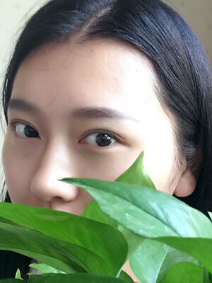 双眼皮失败修复手术恢复超自然，看起来一点都不假