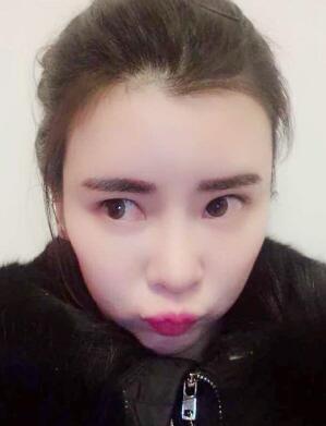 自体脂肪填充太阳穴