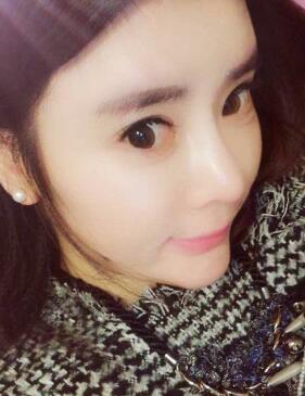 自体脂肪丰太阳穴两个半月