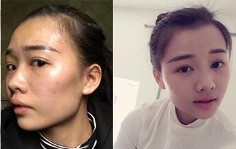 自体脂肪填充全脸整形前后对比图