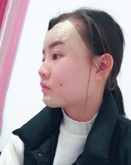 自体脂肪面部填充整形果图