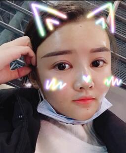 自体脂肪面部填充第三天