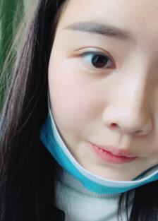 自体脂肪面部填充恢复一个月