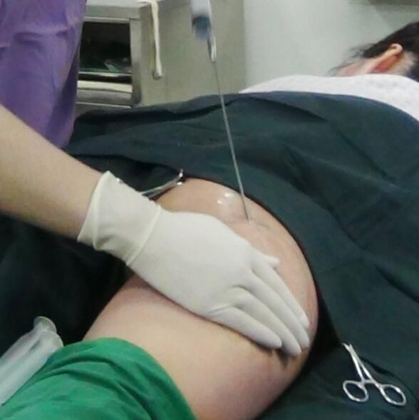 自体脂肪面部填充后我不再依赖p图软件了