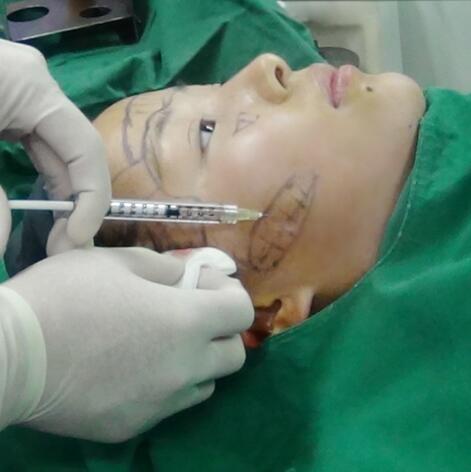 自体脂肪面部填充后我不再依赖p图软件了