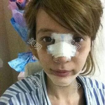 我的自体脂肪隆鼻+垫下巴恢复过程