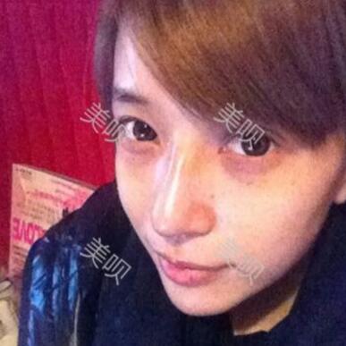 我的自体脂肪隆鼻+垫下巴恢复过程