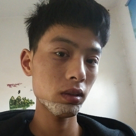 内切去眼袋+切开割双眼皮恢复过程和前后对比果图片分享哦~