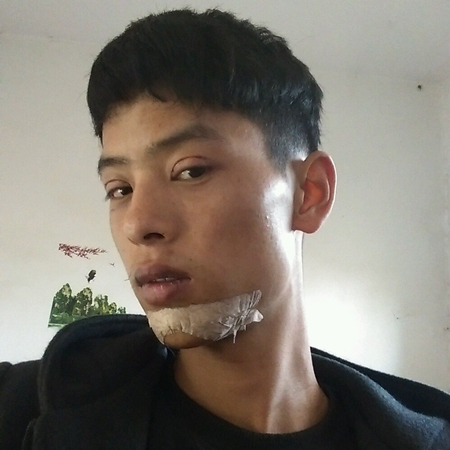 内切去眼袋+切开割双眼皮恢复过程和前后对比果图片分享哦~