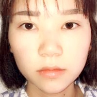 鼻子整形价格10000元，隆鼻手术过程图分享