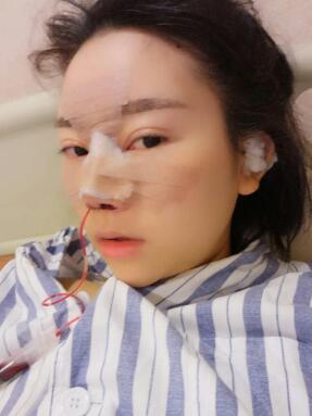 鼻子整形手术过后