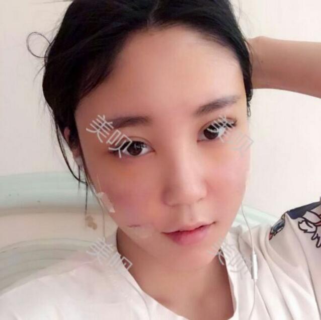 自体脂肪丰苹果肌后我凹陷显老的面部终于变得年轻啦