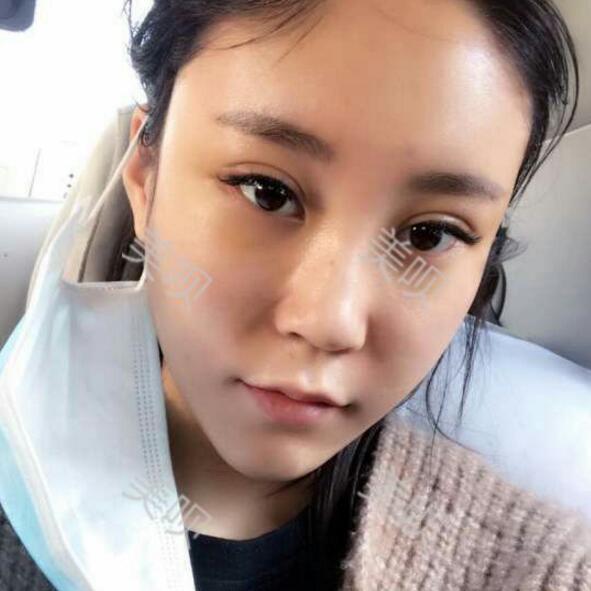 自体脂肪丰苹果肌后我凹陷显老的面部终于变得年轻啦