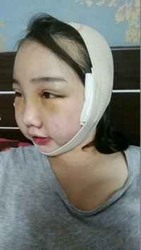 颧骨整形手术后，我也可以拥有精致小脸了