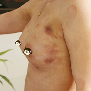 深圳美源做的自体脂肪隆胸，大家来看看果如何?