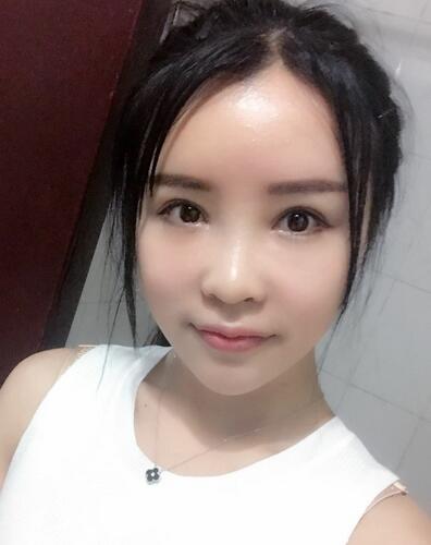 自体脂肪填充全脸恢复经历