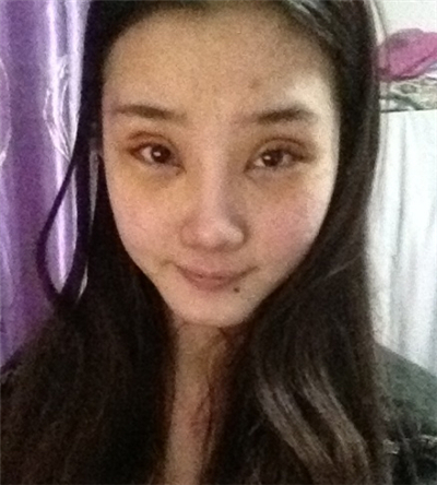 激光去雀斑+华尔兹冰点脱全身毛术后恢复过程照片分享~~