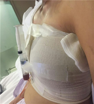娜绮丽假体隆胸手术两个月了，分享手术过程跟前后对比果照片哦~