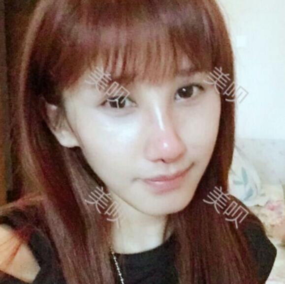 膨体隆鼻后我也有了像明星那样的小翘鼻了
