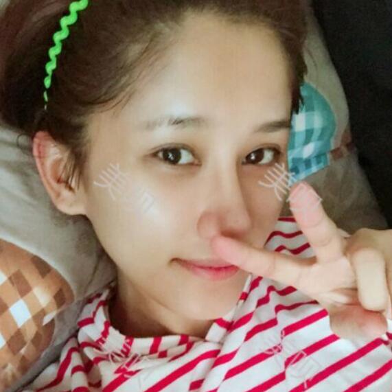 膨体隆鼻后我也有了像明星那样的小翘鼻了