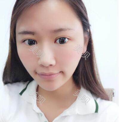 自体脂肪面部填充后脸上有胶原蛋白的感觉真爽