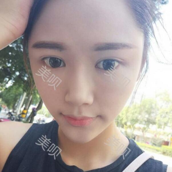 自体脂肪面部填充后脸上有胶原蛋白的感觉真爽