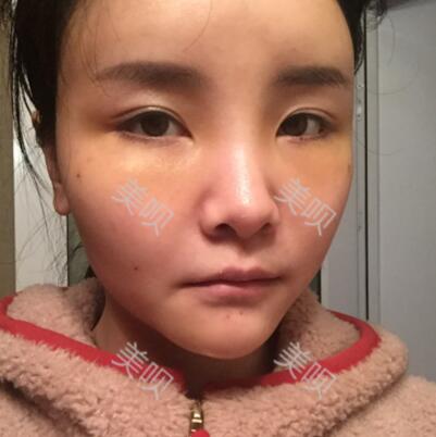 自体脂肪面部填充40天的恢复过程给大家做个参考