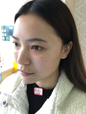 去年12月做的自体脂肪填充苹果肌，大家来看看果怎么样?