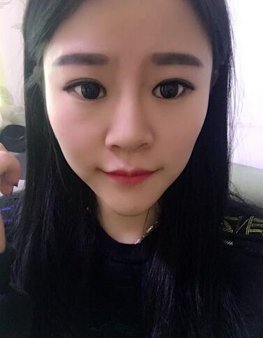 玻尿酸隆鼻恢复过程图