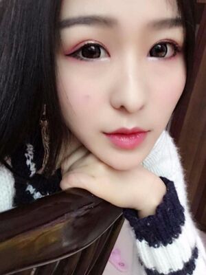 双眼皮修复+开眼角真实案例 对比图分享